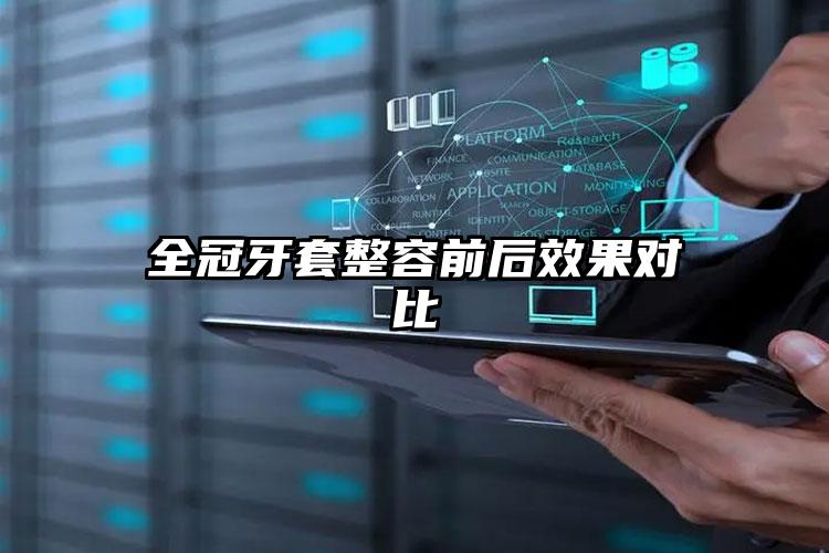 全冠牙套整容前后效果对比